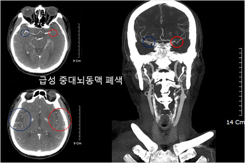 <척추학 932, 글미 20-4-1> / 그림 20-4-1, 남녀 연령에 따른 골량의 변화 / 최대 골량의 형성은 약 30세 전후까지 이루어지며, 이때는 골형성이 골흡수보다 많이 발생하여 골량의 증가가 유지되며, 이러한 골량의 증가는 사춘기 전후에 가장 왕성하게 일어난다. 30~50세 정도까지는 어느 정도 평탄한 소량의 골량 감소를 보이지만 여성은 폐경기에 해당하는 50세 전후에 여성호르몬 결핍으로 골형성보다 골흡수 과정이 향진된 결과로 급작스런 골량의 감소가 발생하게 된다. 유전적으로 남성이 여성보다 최대 골량이 높게 형성되며, 남성은 여성과 같은 급격한 호르몬 변화가 없어 50세 이후에도 비교적 완만한 골감소를 보여 골정의 발생 위험도가 상대적으로 여성에 비해 낮다.